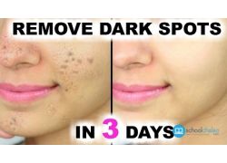 school-chalao-in-3-days-remove-dark-spots-black-spots-acne-scars.jpg